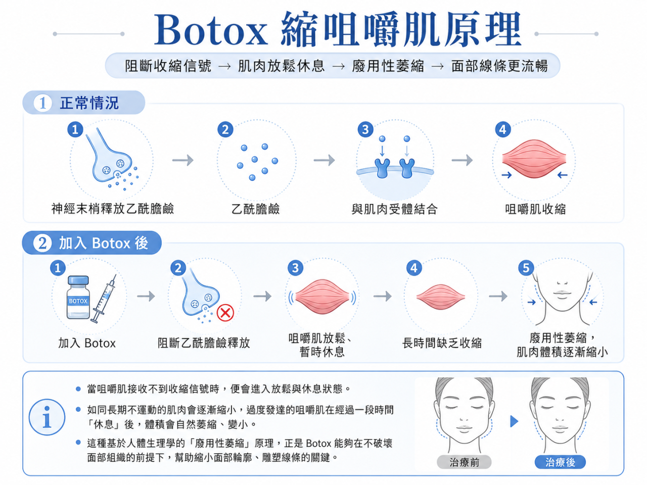 Botox 瘦面的科學原理與機制