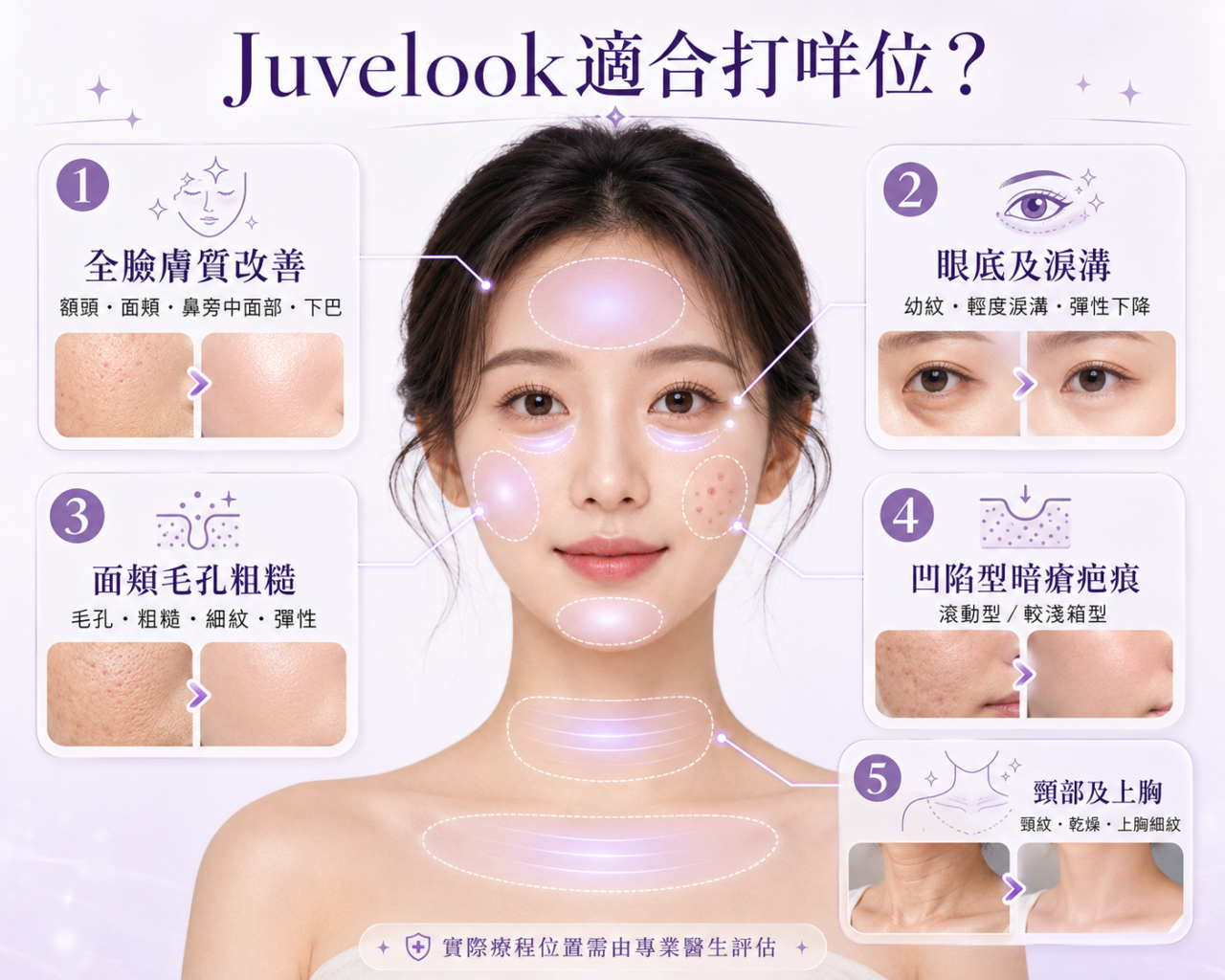Juvelook適合施打位置