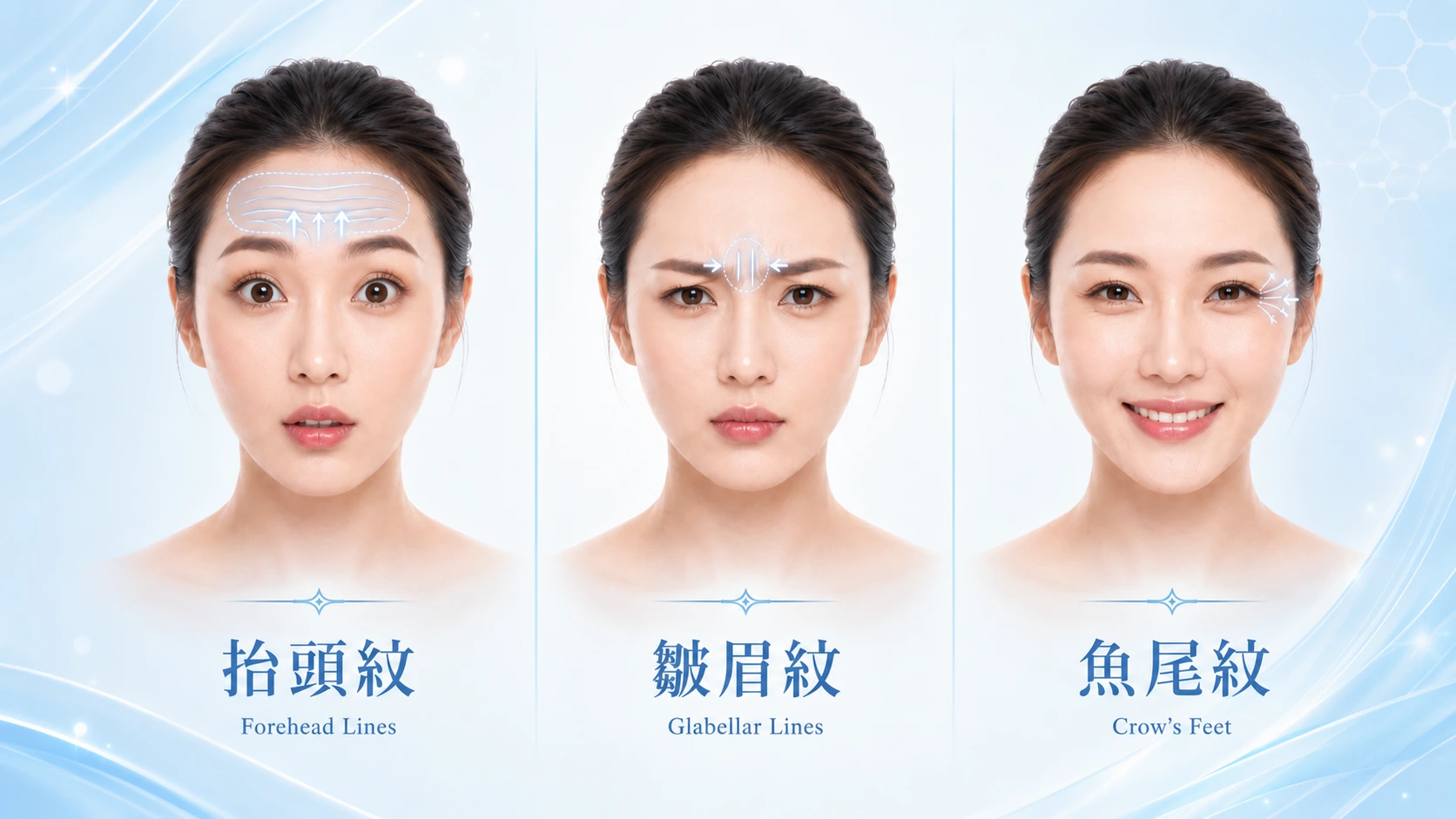 三大上面部表情紋的重點評估方向
