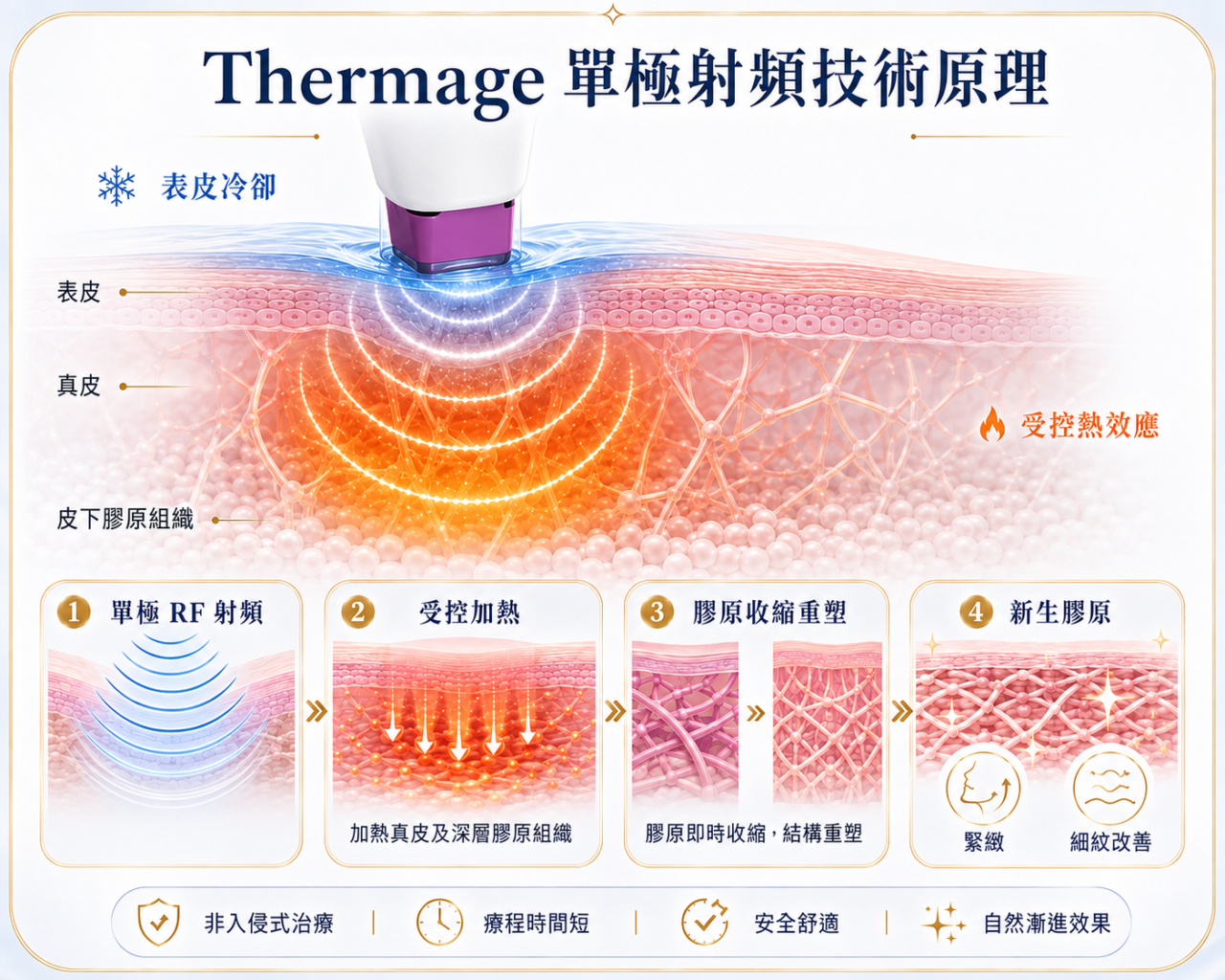 Thermage RF射頻技術原理