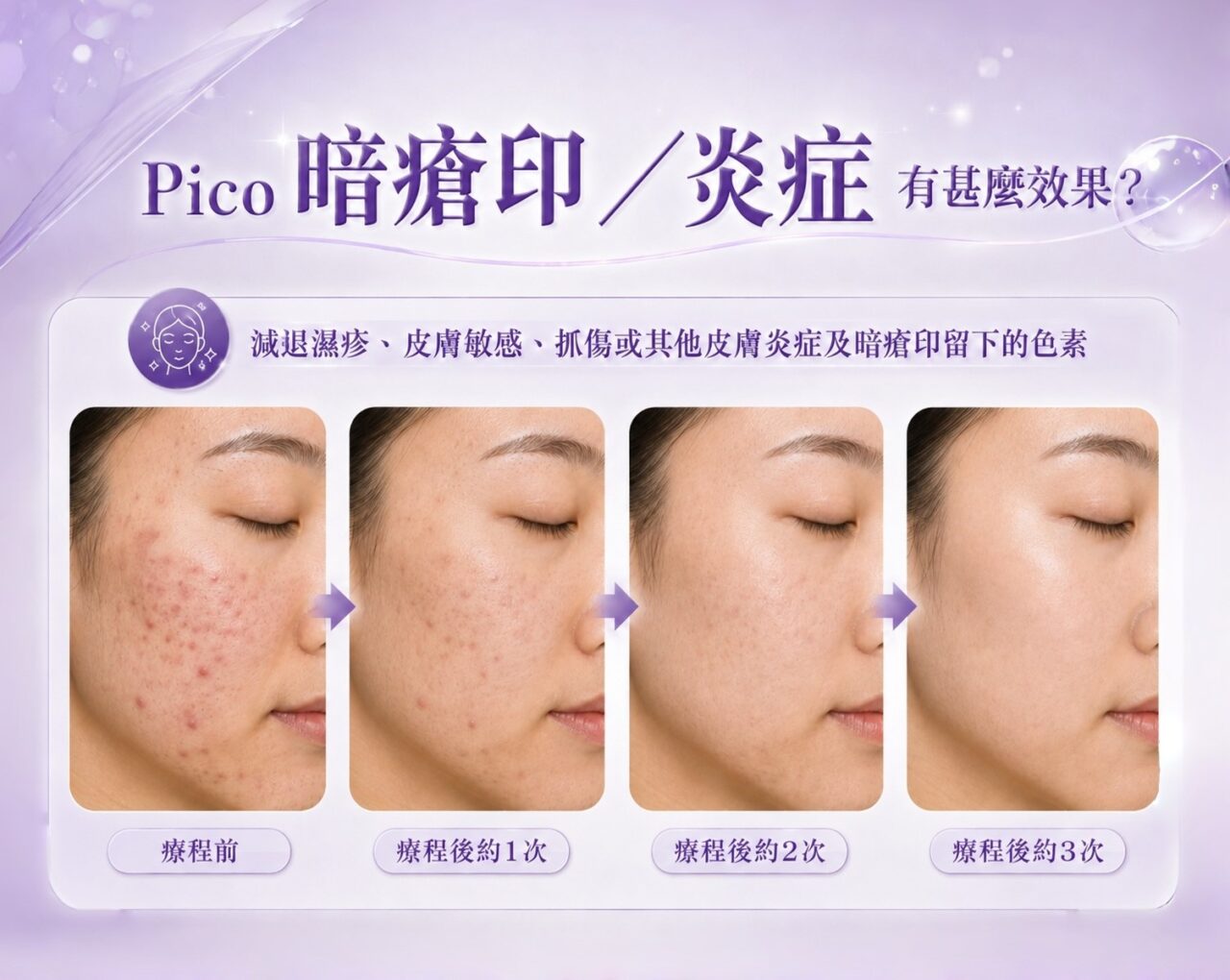 Pico效果（暗瘡印）
