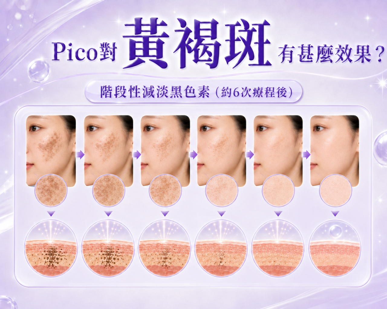 Pico效果（黃褐斑）